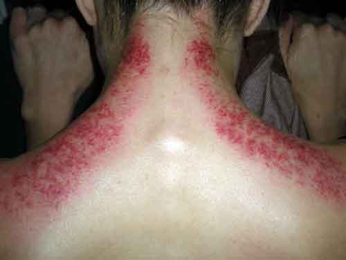 Showing the red marks from Gua Sha